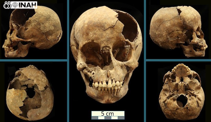 Nuevo estudio refuerza la teoría del origen americano de la sífilis antes de la llegada de Colón